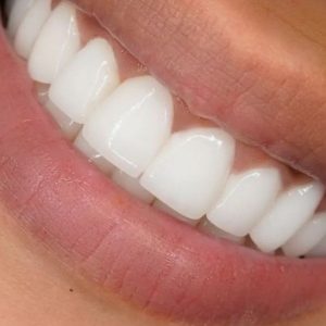 تجريف لثة مغلق فك واحد