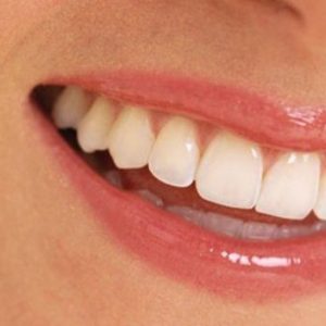 زراعة سن زركونيا (لايشمل التركيبة)