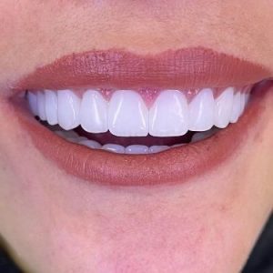 علاج عصب سن خلفي - اللب حي