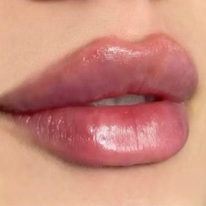 تجميل شفة فيلر