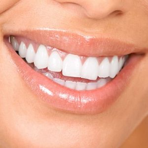 قص لثة للفك الواحد