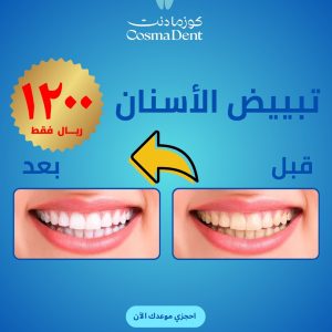 تبييض الأسنان
