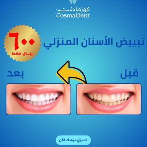تبييض الأسنان المنزلي