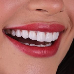 لحام طقم مكسور