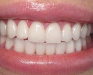 orthodontic braces correction
