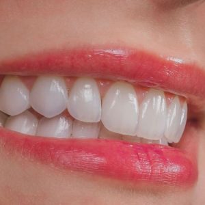 orthodontic one session