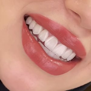 تاج أكريلك مؤقت